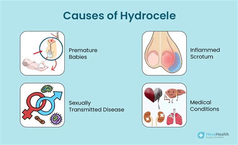 Hydrocele - Meaning, Symptoms, and Causes