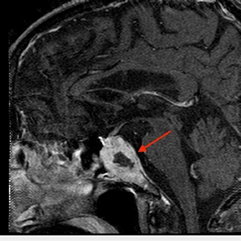 Sagittal MRI of the metastatic lesion abutting the optic chiasm (arrow ...