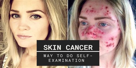 Skin Cancer Early Self Examination | What You Can Do As Inspection For ...