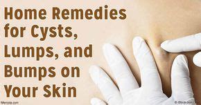 There are many types of skin cysts; the most prevalent are epidermoid, pilar or… | Home remedies ...