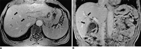 Figure 2:MR Imaging Findings of Clonorchiasis- Open-i