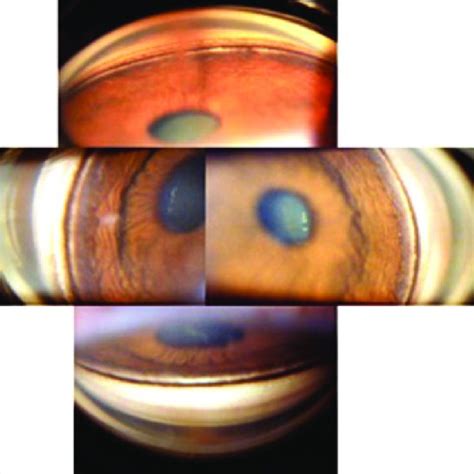 Gonioscopic appearance of the right eye, note the angle... | Download Scientific Diagram