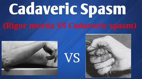 Cadaveric spasm | Difference between Rigor mortis & Cadaveric spasm ...