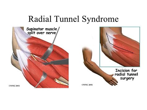 radial tunnel syndrome - Google Search