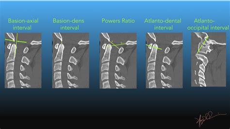 Normal Adult Craniocervical Measurements on CT | UW Emergency Radiology