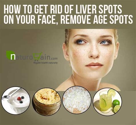 How to Get Rid of Liver Spots on Your Face Fast? | Age spot removal, Age spots, Age spots on face