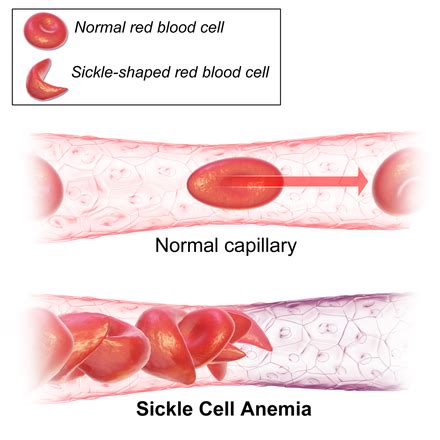 Sickle cell disease - Wikipedia