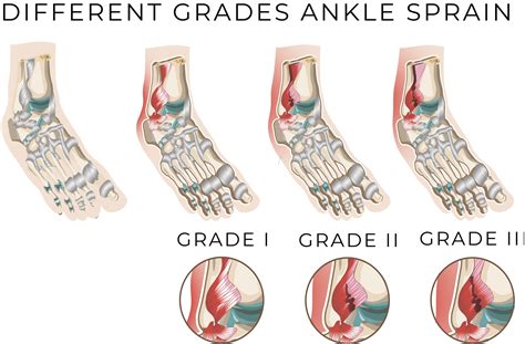 SPRAINS AND STRAINS - AVALA