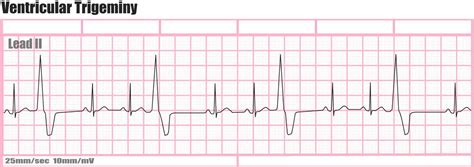 Holter monitor uses, instructions, preparations and Holter monitor results