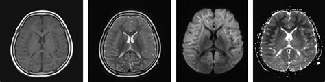 “Bright tree” appearance in ALERD – Radiology Cases