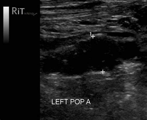 Figure 1: Gray-scale ultrasound of the let popliteal ultrasound shows a fusiform aneurysm of the ...