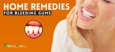 10 Best Home Remedies for Bleeding Gums That Give [Fast] Relief