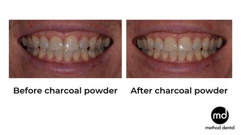 Charcoal Toothpaste Dentist Review: Carbon Coco, Colgate, WhiteGlo ...