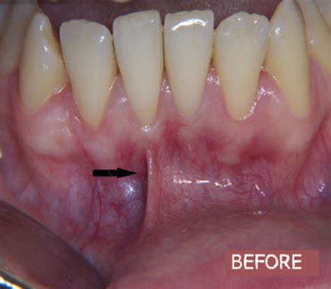 FRENECTOMY OR FRENOTOMY 2a - Dental Pro Clinic