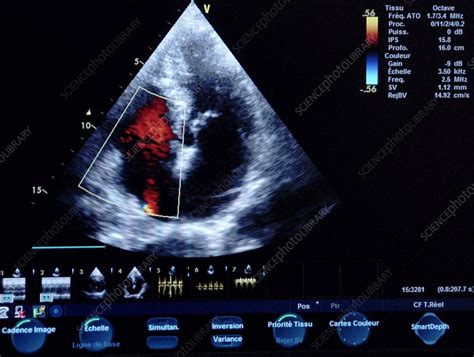 Heart ultrasound scan - Stock Image - C009/8334 - Science Photo Library