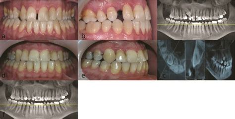 Patient 2. a: Frontal occlusion photograph before treatment, b: Lateral ...