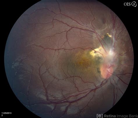 Optic Nerve Tumor - Retina Image Bank