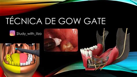 Técnica de Gow Gate | Studywithitza | uDocz