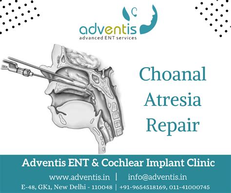 Children Choanal Atresia Repair Treatment in Delhi | Adventis