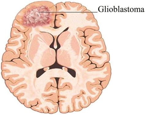 Deep-belief networks detect glioblastoma tumors from MRI scans