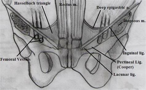 Groin Hernia