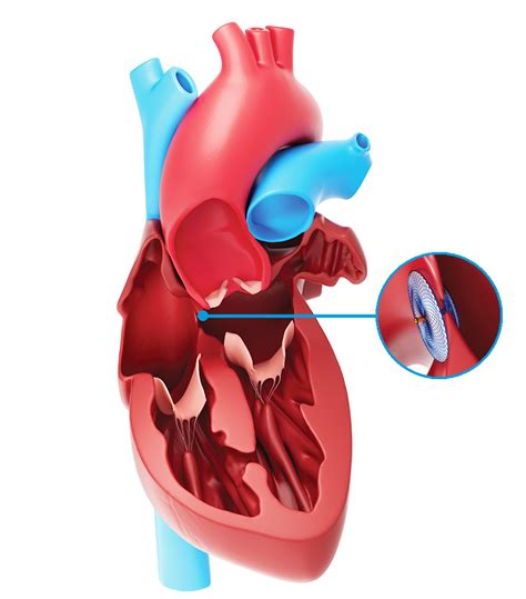 Patent Foramen Ovale Treatment | PFO Closure