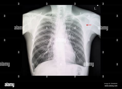 Tuberculosis X Ray Cavitation