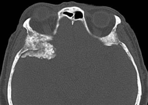 Sphenoid Wing Meningioma - Neuro MR Case Studies - CTisus CT Scanning