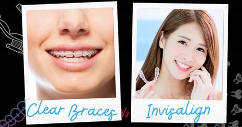 Clear Braces vs. Invisalign: 12 Main Differences | 2024 Guide