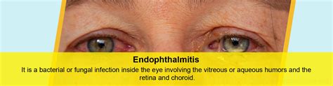 Endophthalmitis - Causes, Symptoms, Diagnosis, Treatment & Prevention