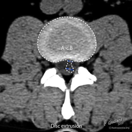 Disc extrusion | Radiology Reference Article | Radiopaedia.org