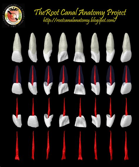 The Root Canal Anatomy Project: Maxillary Central Incisor