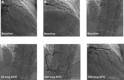 Coronary Artery Vasospasm Requiring Cardiac Autotransplantation Yet ...