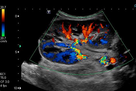 Renal Transplant Duplex Ultrasound | Cedars-Sinai