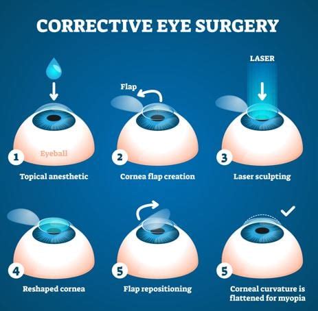 All About Laser Eye Surgery. Correct your Myopia in 10 minutes