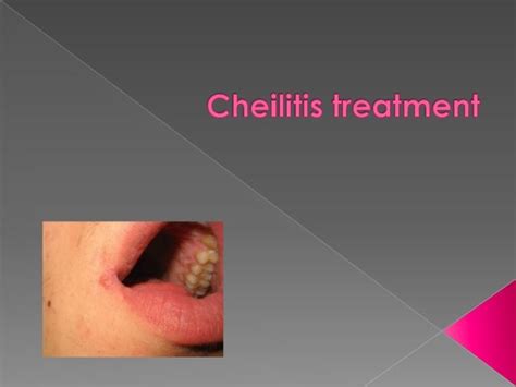 Cheilitis treatment