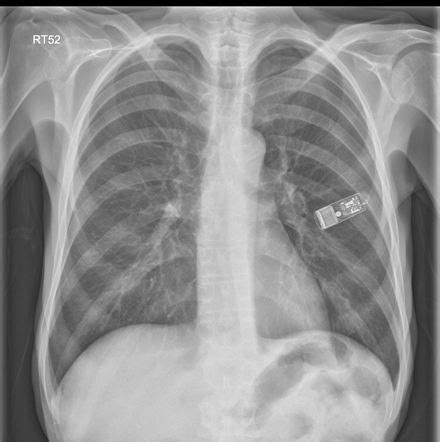 Implantable loop recorder device | Radiology Case | Radiopaedia.org