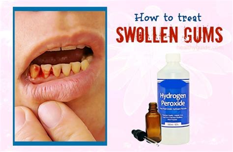 34 Tips How to Treat Swollen Gums around Tooth and Cheek Fast