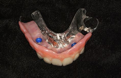 Snap-On Dentures - Dr. Eskow Prosthodontics