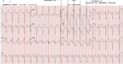 Dr. Smith's ECG Blog: Severe Right Ventricular Hypertrophy