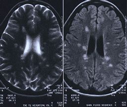 MRI images showing multiple sclerosis