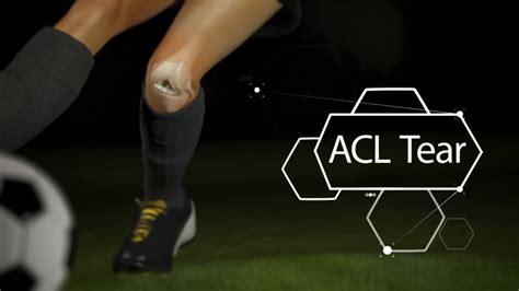 ACL Tear and Injury Management for An Athlete