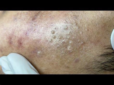 Relax Every Day With Sac Dep Spa #0256 - YouTube | Ear pimple, Spa, Whitening