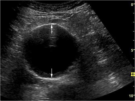 Ultrasound Leadership Academy: Aortic Ultrasound — EM Curious