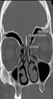 Dehiscence of Lamina Papyracea a Normal Variation: A Case Report in Iran | Journal of Kermanshah ...