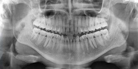 The Role Of X-Rays In Periodontal Disease Diagnosis - Upper East Side New York, NY: The Center ...