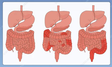 Crohn's Disease & Ulcerative Colitis, Comparison - Stock Image - C036 ...