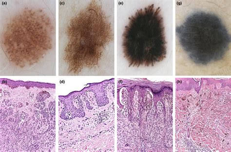 Junctional Melanocytic Nevus