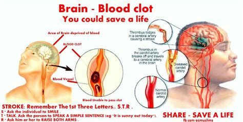 Brain Blood Clot : What to Do In Brain Attack