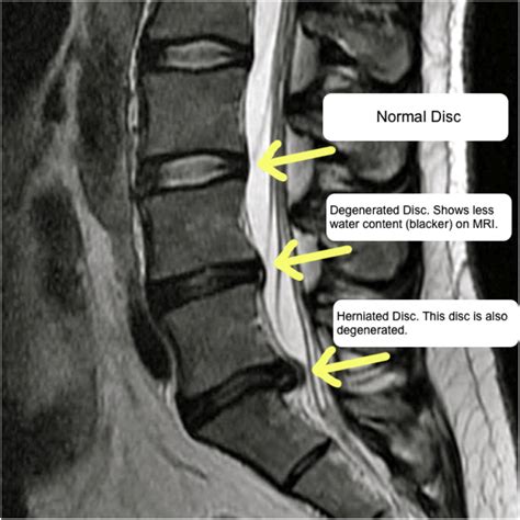 Treatment options and pathophysiology of degenerative spine disease - Surgery - Oxford ...